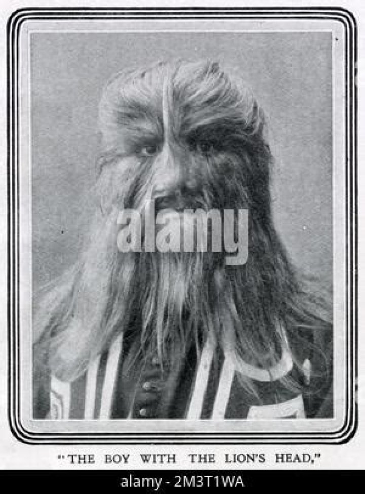 Stephan Bibrowski, A Sideshow Performer Known As The 'Lion-Faced Man'